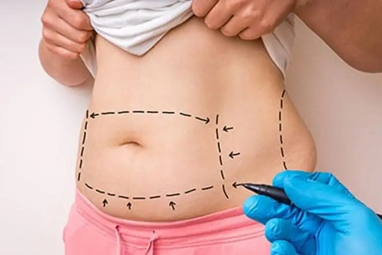 Abdominoplastia