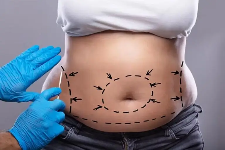 Cirurgia Pós Bariátrica