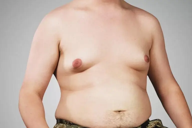 Ginecomastia