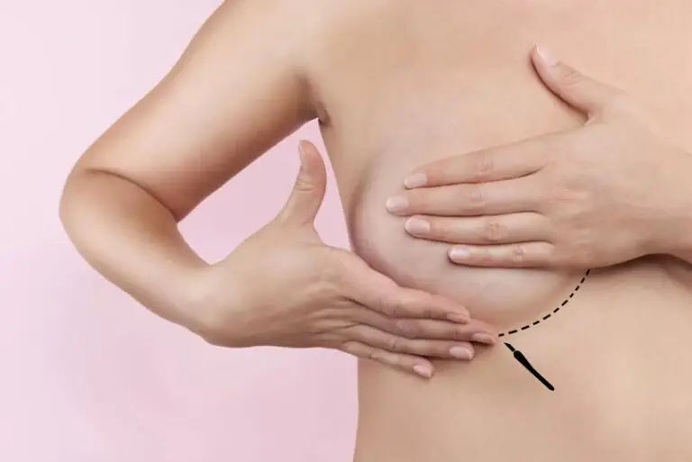 Mamoplastia Redutora