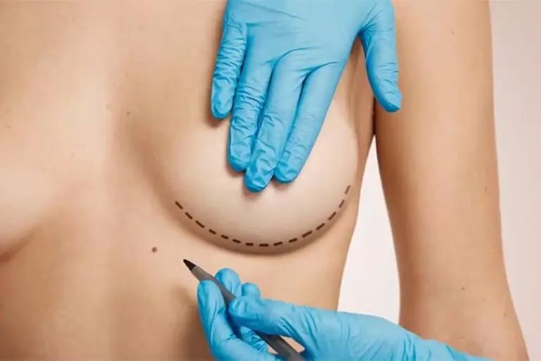 Mamoplastia de Aumento